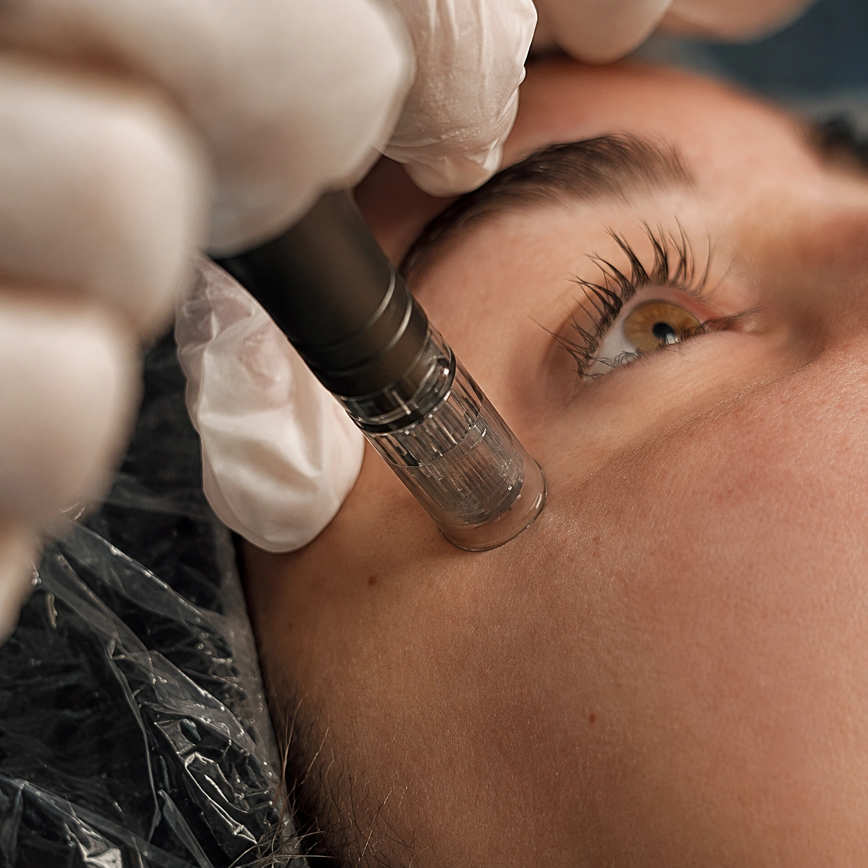 Microneedling professional training